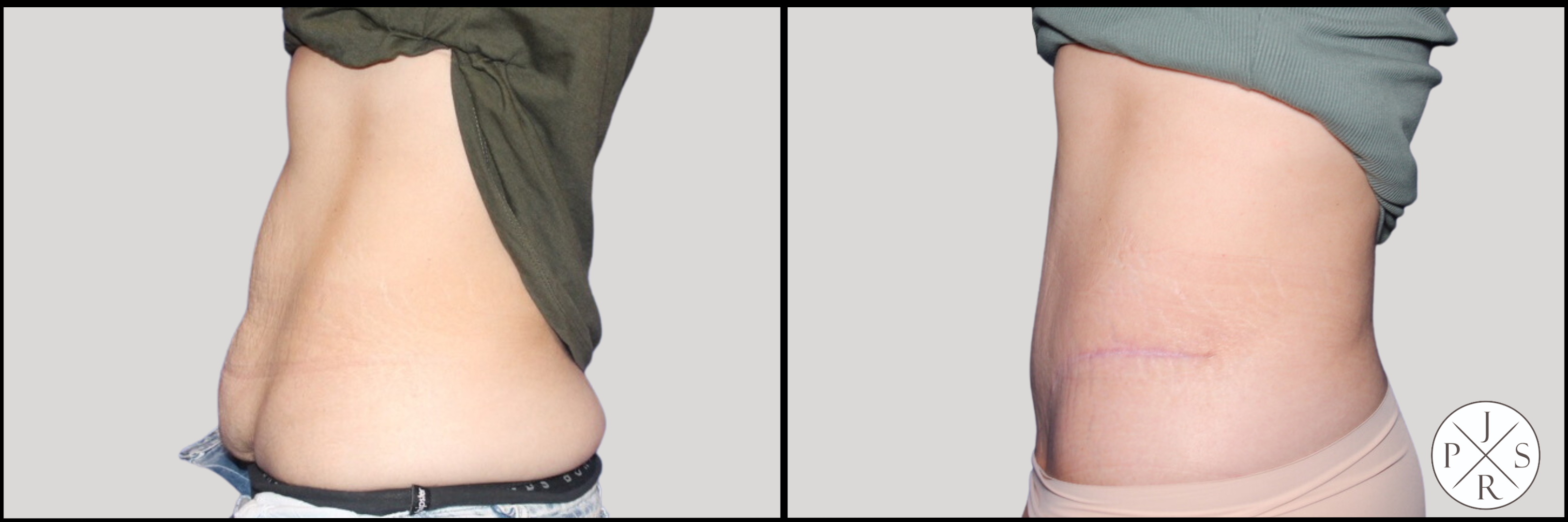 Abdominoplasty Before & After Image